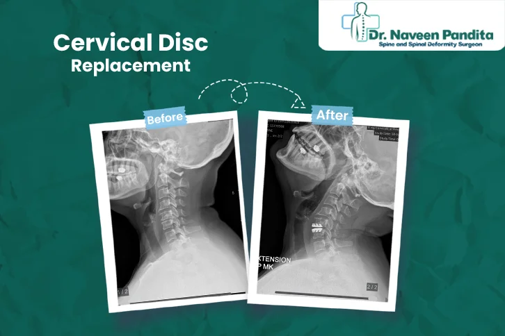 Disc Replacement Surgery